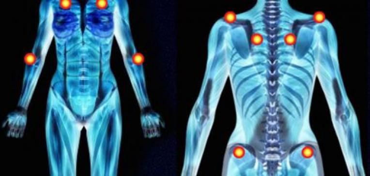 Fibromyalgie: Wie damit leben? Image